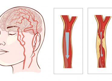 I consigli del cardiologo per prevenire un ictus cerebrale