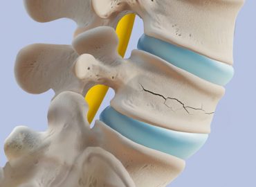 Cedimenti della colonna vertebrale in caso di osteoporosi: cosa sapere