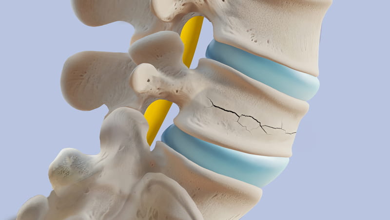 Cedimenti della colonna vertebrale in caso di osteoporosi: cosa sapere