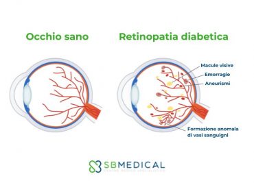 Retinopatia diabetica: prevenzione e gestione della vista nei pazienti con diabete