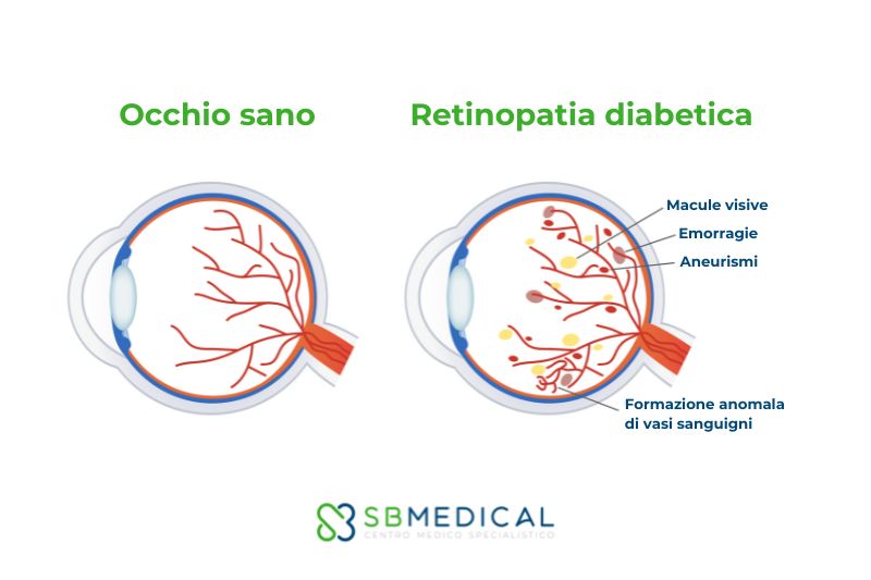 Retinopatia diabetica: prevenzione e gestione della vista nei pazienti con diabete