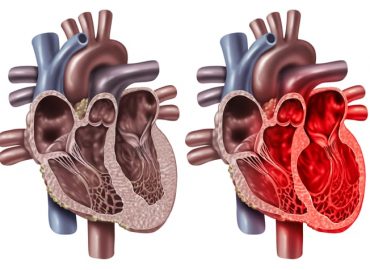 Sindrome di Tako-tsubo: il misterioso "cuore infranto" che simula l'infarto