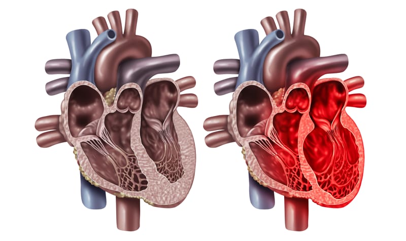 Sindrome di Tako-tsubo: il misterioso “cuore infranto” che simula l’infarto